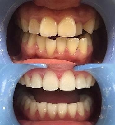 брекеты цена бишкек 2020: К вашему вниманию предоставляется услуга по установке брекет-системы — 5