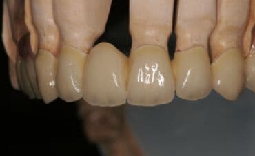 обучение медсестры: Обучение зубных техников металлокерамика восковое моделирование — 3