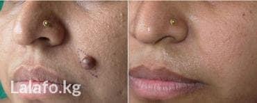 эко спрей от вшей как пользоваться: Средство для удаления бородавок, родинок и папиллом doctor wei speckle — 2