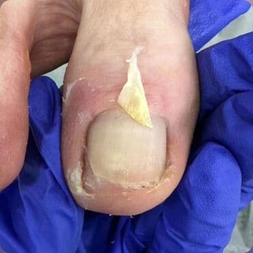 кресло барбер: Вросший ноготь установка скобы unibrace,фрезер, 3то титановая нить — 1