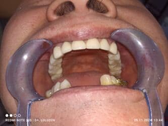 хиджама кровопускание: Клиника | Стоматолог | Протезирование — 14