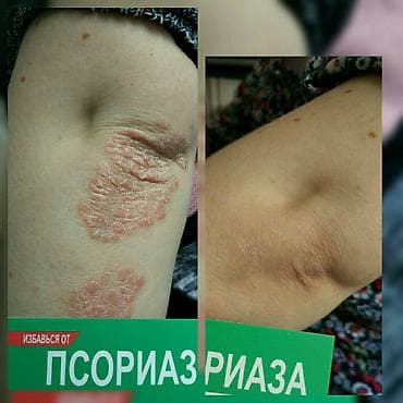 мазь: Здравствуйте! Найден эффективный способ от Псориаза. Я сам болею этой — 2