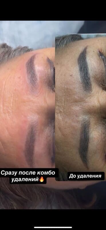 хиджама кровопускание: АКЦИЯ !АКЦИЯ! Новый метод удаления Сейчас по акции Лазерное удаление — 17