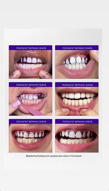 накладные зубы: Полоски для отбеливания Зубов smilekit 100% гарантия на то что после — 2