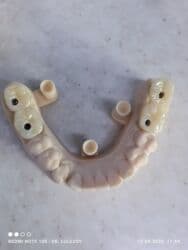 хиджама кровопускание: Клиника | Стоматолог | Протезирование — 22