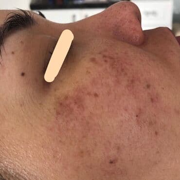 хиджама кровопускание: Косметология, Чистка кожи, Биоревитализация, Пилинг, Сертифицированный косметолог, Гипоаллергенные материалы, Консультация — 8