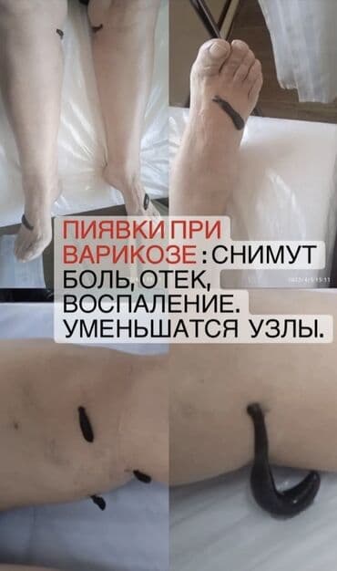 самый лучший гинеколог в бишкеке: Клиника, Дарыгерлер | Гирудотерапевт | Консультация, Диагностика, Пиявкалар менен дарылоо — 4