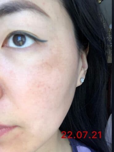 эффективный отбеливающий крем для зоны бикини в аптеке: Expigment Экспигмент Сроки до 2027 Свежая поставка с Турции 🇹🇷 💯% — 16