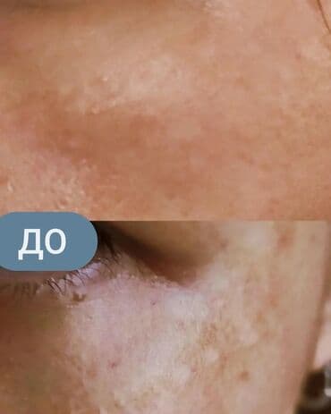 эффективный отбеливающий крем для зоны бикини в аптеке: Expigment Экспигмент Сроки до 2027 Свежая поставка с Турции 🇹🇷 💯% — 7