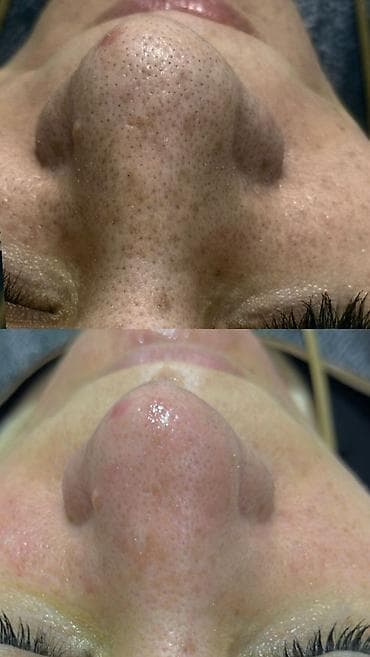 Профессиональная чистка лица + карбокситерапия в подарок!!! - at lalafo.kg Профессиональная чистка лица + карбокситерапия в подарок!!! -