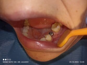 хиджама кровопускание: Клиника | Стоматолог | Протезирование — 18