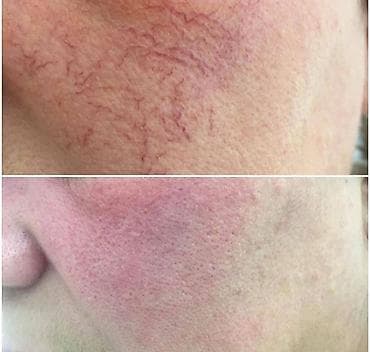 samsung 21: Удаление сосудистых звёздочек и купероза на лице - Аппаратная — 4