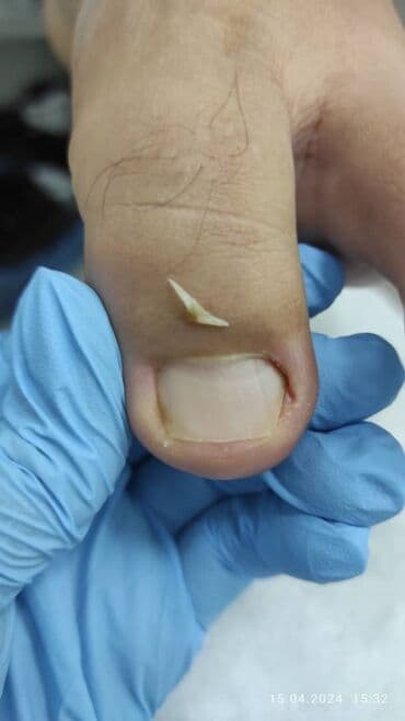 медсестра на дом бишкек мкр: Выравнивание, Наращивание ногтей, Донаращивание ногтей, Маникюр, Педикюр, Услуги подолога, С выездом на дом, Консультация, Одноразовые расходные материалы — 8