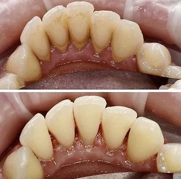 карбоновый пилинг: Профессиональная гигиена полости рта: снятие зубного камня и — 4