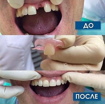 клиника дентомакс бишкек: Лечение кариеса 
Фотопломба
Чистка
Удаление 
Протезирование — 8