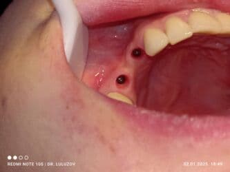 хиджама кровопускание: Клиника | Стоматолог | Протезирование — 4