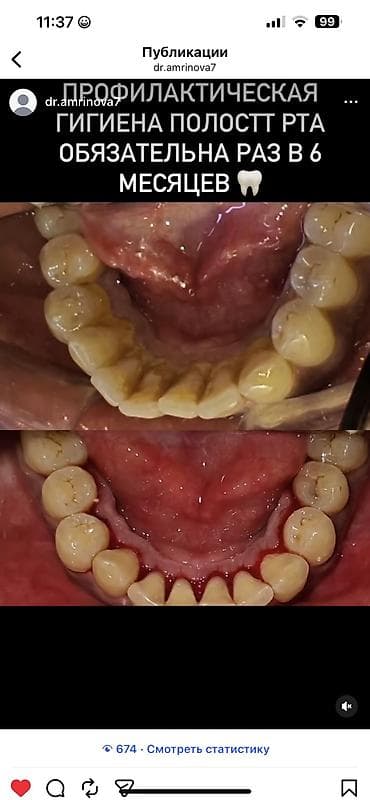 Сетевой маркетинг: Профессиональная гигиена полости рта: снятие зубного камня и мягкого — 1