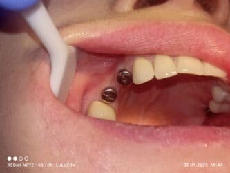 хиджама кровопускание: Клиника | Стоматолог | Протезирование — 2