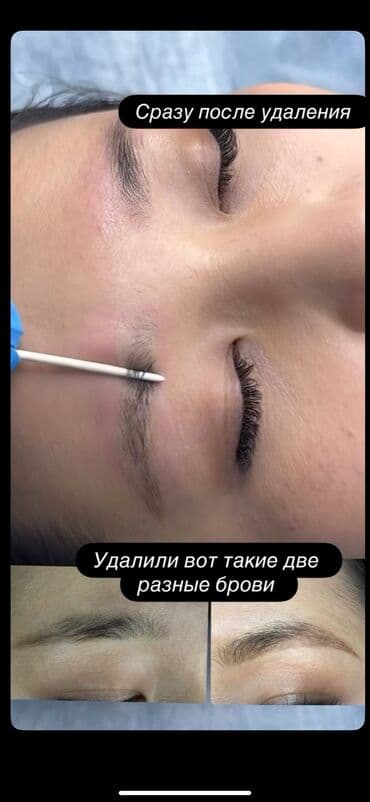хиджама кровопускание: АКЦИЯ !АКЦИЯ! Новый метод удаления Сейчас по акции Лазерное удаление — 1