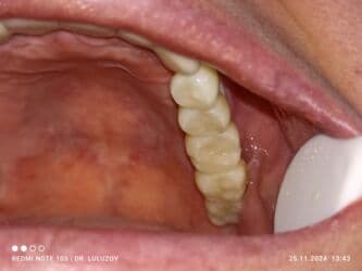 хиджама кровопускание: Клиника | Стоматолог | Протезирование — 15