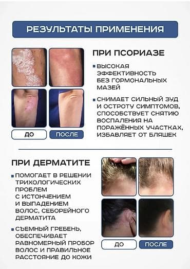 Медициналык лампалар: Уф лампа витилиго 311 нм – передовое решение для эффективной домашней — 4