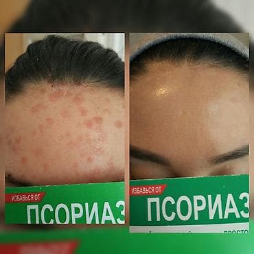 мазь: Здравствуйте! Найден эффективный способ от Псориаза. Я сам болею этой — 7