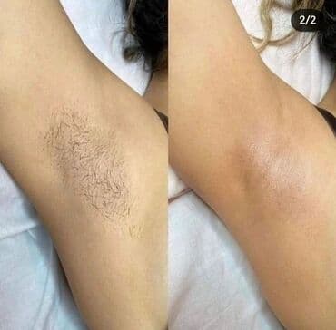 хиджама кровопускание: Акция все тело за 1200 сом.Шугаринг — профессиональная сахарная — 10