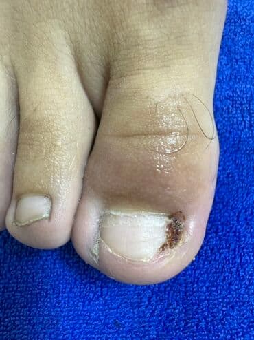 1.	✨ Акция! Обработка вросшего ногтя всего 600 сом. Запишитесь сейчас