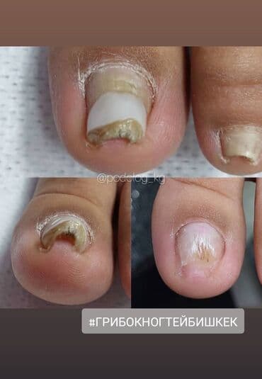 выезд мастера на дом маникюр и педикюр: Коррекция вросших ногтей, Услуги подолога, Педикюр, Маникюр, Консультация, Одноразовые расходные материалы — 3