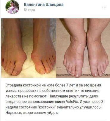 Кислородные подушки: Valufix- hallfix фиксатор от вальгусной деформации +бесплатная — 9