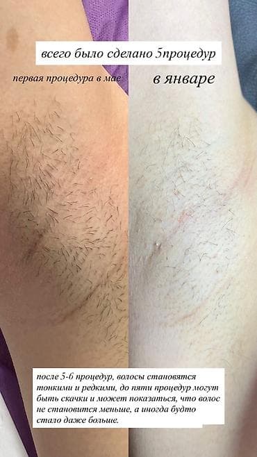 Сулуулук жана ден-соолук: Электроэпиляция — профессиональное удаление волос с любой зоны — 1