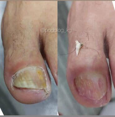 выезд мастера на дом маникюр и педикюр: Коррекция вросших ногтей, Услуги подолога, Педикюр, Маникюр, Консультация, Одноразовые расходные материалы — 2