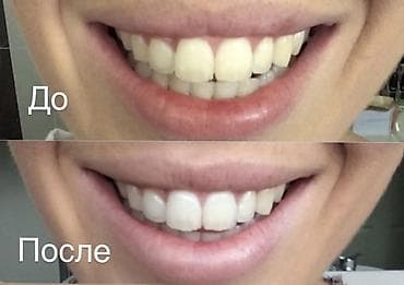 накладные зубы: Полоски для отбеливания Зубов smilekit 100% гарантия на то что после — 5