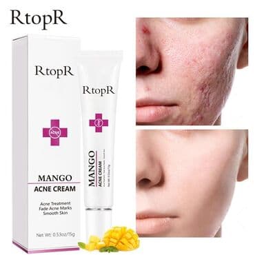 Крем от акне и угрей и после акне Mango