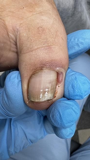 Коррекция вросших ногтей, Педикюр, Услуги подолога, Консультация