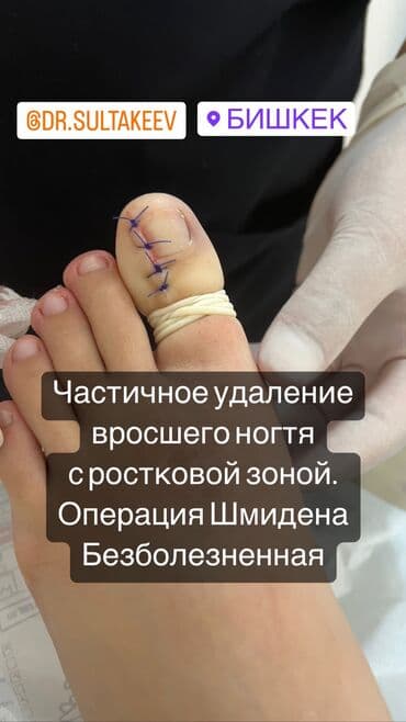 нокти: Вросший ноготь (онихокриптоз) — это врастание ногтевой пластинки в — 2