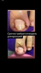 Коррекция вросших ногтей, Услуги подолога, Требуются модели