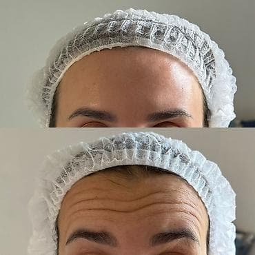 НУЖНЫ МОДЕЛИ НА БОТОКС .Инъекционная коррекция мимических морщин лба