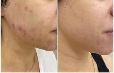 самый лучший эндокринолог рядом просп жибек жолу бишкек: Косметология, Контурное моделирование, Лечение угревой болезни, Маски, Консультация, Гипоаллергенные материалы, Сертифицированный косметолог — 6