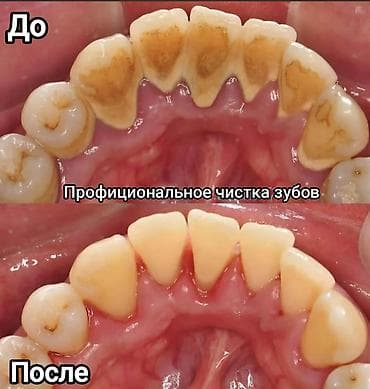 протезы для ног: Съёмные зубные протезы под ваши задачи - Вакуумные протезы: плотная — 7