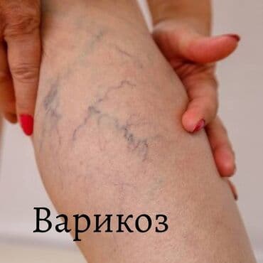 Крем от варикоза. Здоров