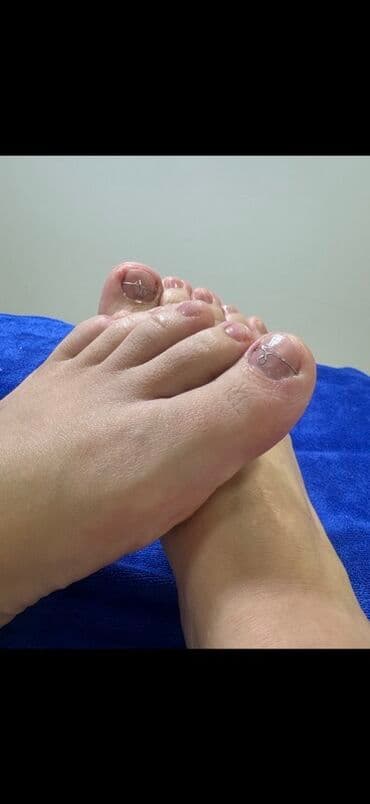 📌 Скобы аккуратно приподнимают края ногтя и направляют его рост at lalafo.kg 📌 Скобы аккуратно приподнимают края ногтя и направляют его рост