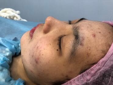 Косметология, Лечение угревой болезни, Биоревитализация, Маски, Консультация, Сертифицированный косметолог at lalafo.kg Косметология, Лечение угревой болезни, Биоревитализация, Маски, Консультация, Сертифицированный косметолог