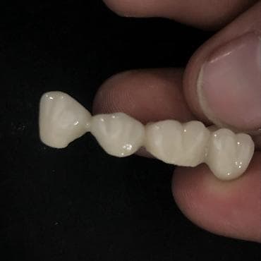 Зуботехнические работы: изготовление несъёмных ортопедических at lalafo.kg Зуботехнические работы: изготовление несъёмных ортопедических