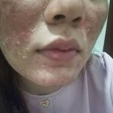 ✨ Пилинг Джесснера 32% у вас дома ✨ Хотите сияющую, обновлённую кожу at lalafo.kg ✨ Пилинг Джесснера 32% у вас дома ✨ Хотите сияющую, обновлённую кожу