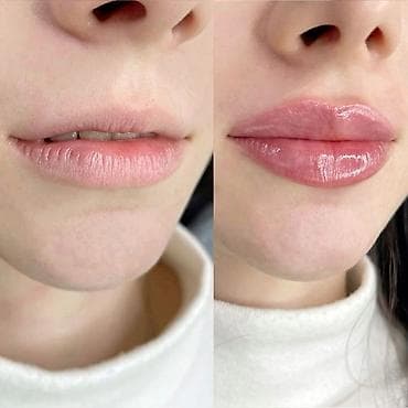 Косметология, Увеличение губ, Консультация, Гипоаллергенные материалы at lalafo.kg Косметология, Увеличение губ, Консультация, Гипоаллергенные материалы