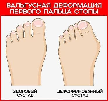 Корректоры от косточки! at lalafo.kg Корректоры от косточки!