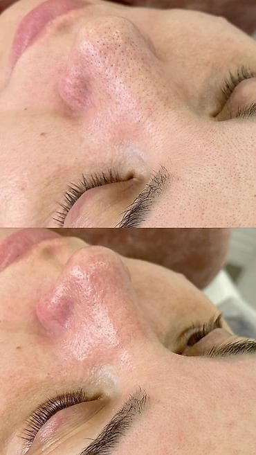 Proton: Профессиональная чистка лица + карбокситерапия в подарок!!! - lalafo.kg да — 8 Proton: Профессиональная чистка лица + карбокситерапия в подарок!!! - — 8